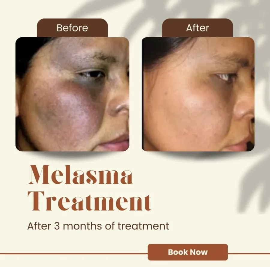 Melasma