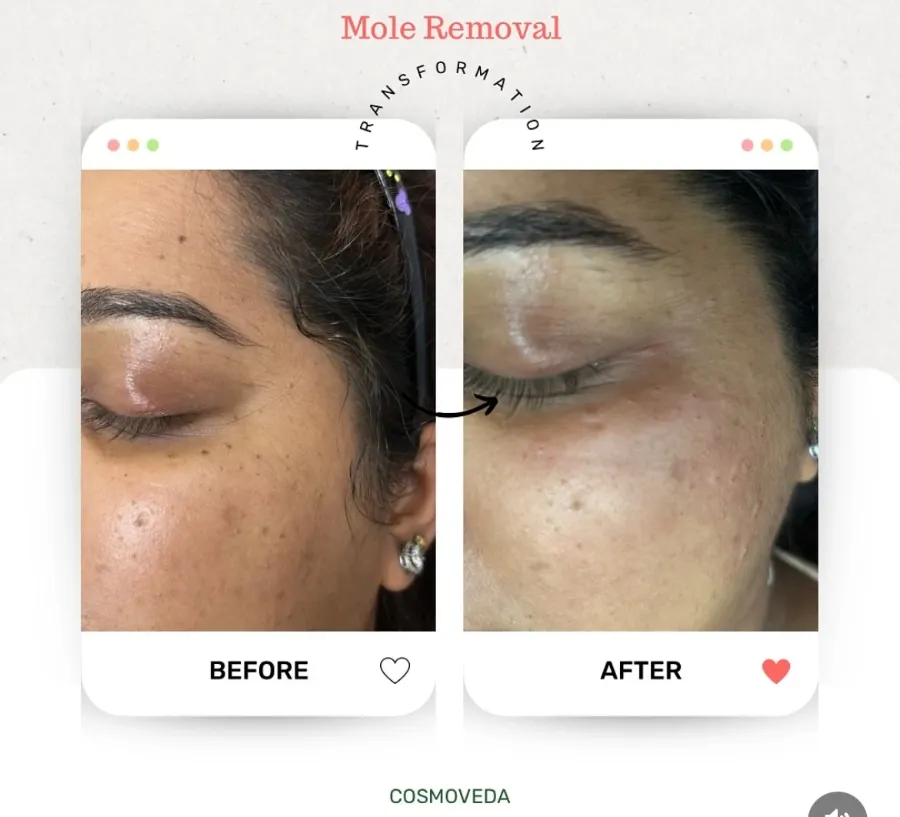 Mole Removal